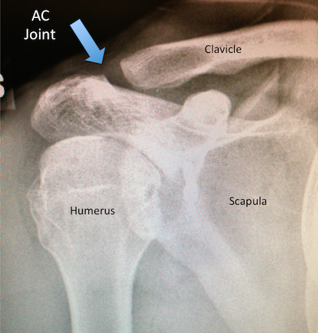 AC Joint X-ray