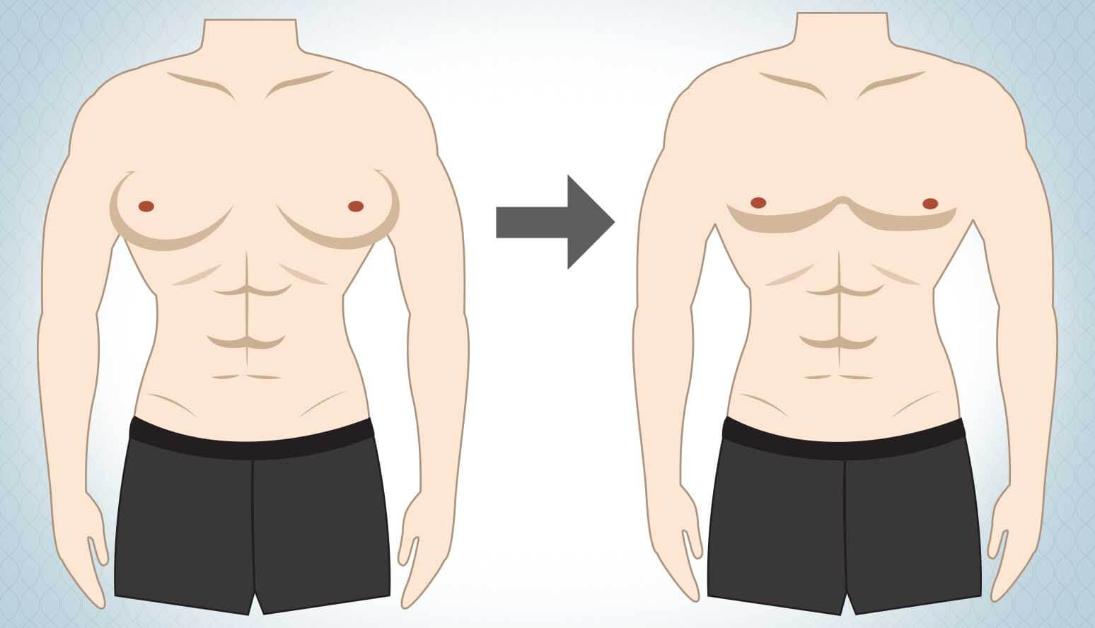 Gynecomastia Diet: Best And Worst Foods To Eat